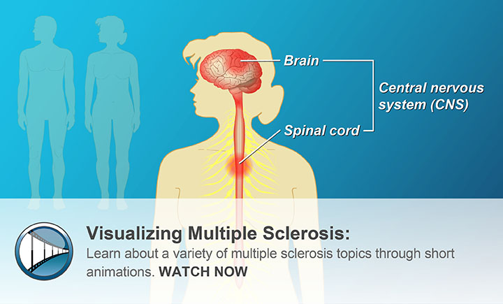 Learn about a variety of multiple sclerosis topics through short animations. WATCH NOW 
